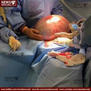 alabama womans 50 pound weight gain turns out to be massive ovarian cyst 1