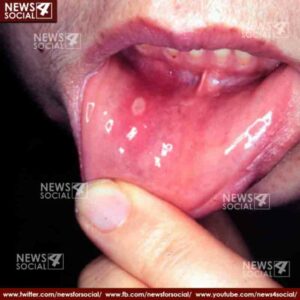 health is wealth presence of this blister can be a sign of mouth 1 cancer