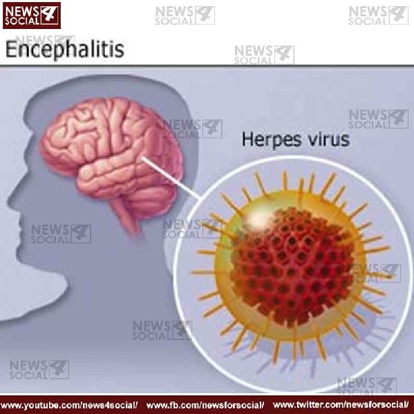 Encephalitis -