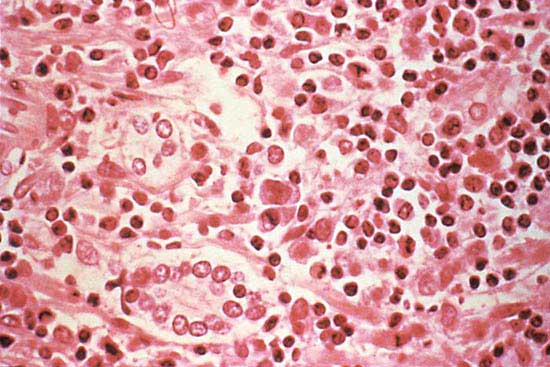 Symptoms of HantaVirus