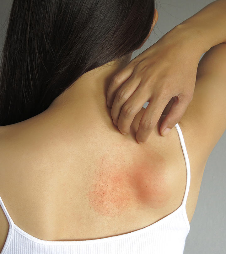 Skin Allergy Symptoms and Home Remedies in Hindi -