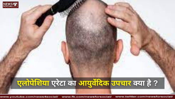 What is the Ayurvedic treatment for Alopecia Areata