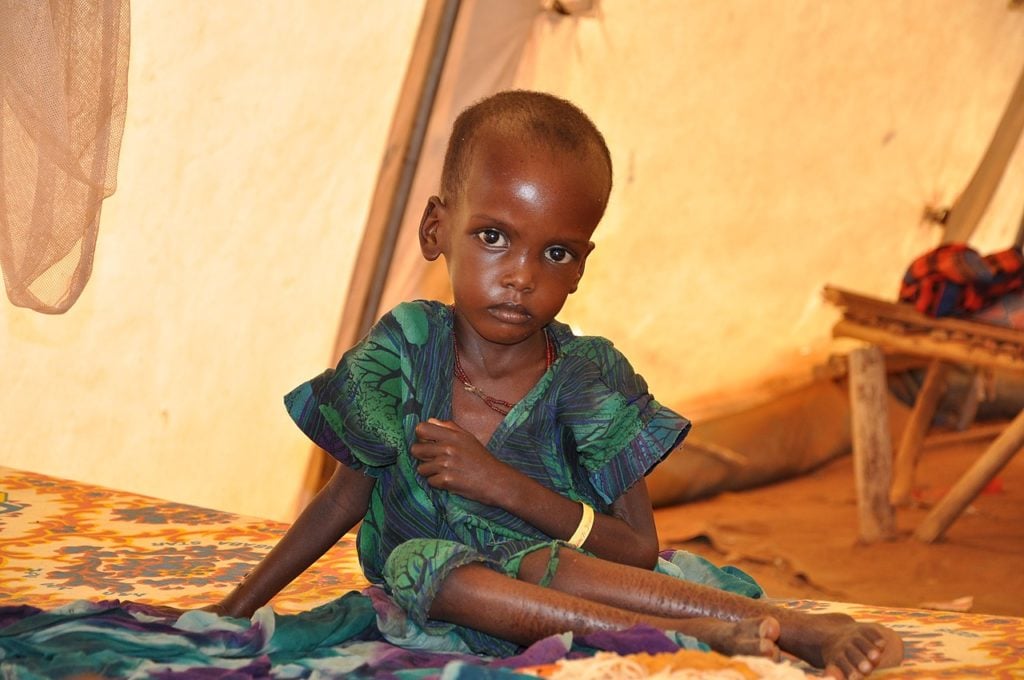 1280px A malnourished child in an MSF treatment tent in Dolo Ado
