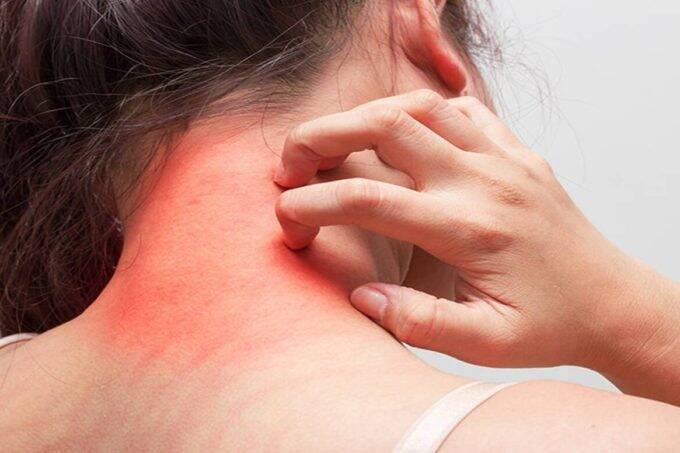 Skin Rash 680x453 1