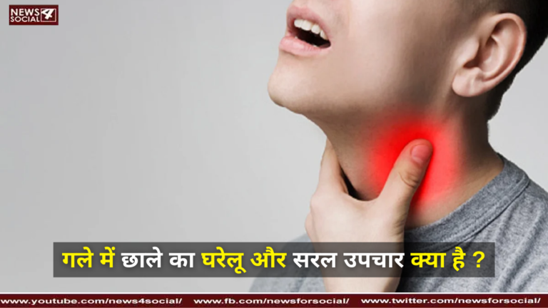 गले में छाले का घरेलू और सरल उपचार क्या है ?