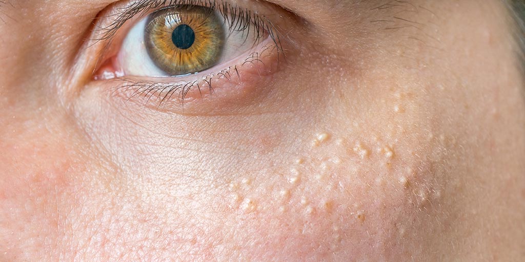 small white bumps under eyes