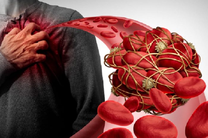Blood Clottinig Heart 001 1200 shutterstock
