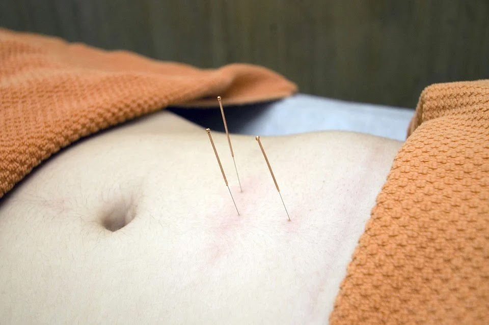 acupuncture 4175624 960 720