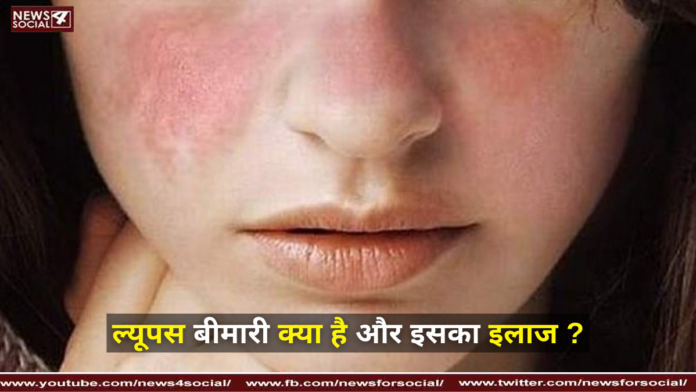 What is lupus disease and its treatment