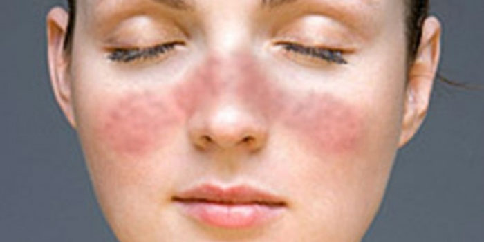 lupus in hindi