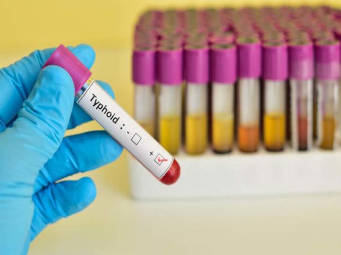 typhoid