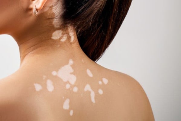 vitiligine dermatologia 1