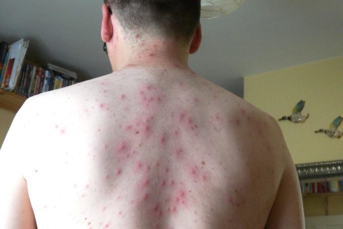 0.42022500 1575452925 small pox