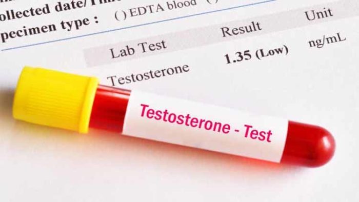 162204508581 Men with low testosterone are at higher risk of covid