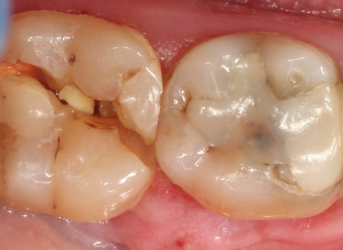 Toothache Dental emergency Castle Hill dentist broken tooth