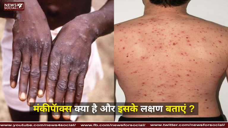मंकीपॅाक्स क्या है और इसके लक्षण बताएं ? ( What is monkeypox and its symptoms? )