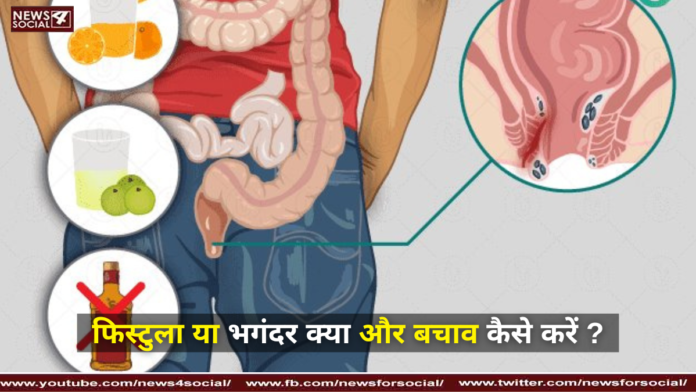 फिस्टुला या भगंदर क्या और बचाव कैसे करें ? ( What and how to prevent fistula ? )