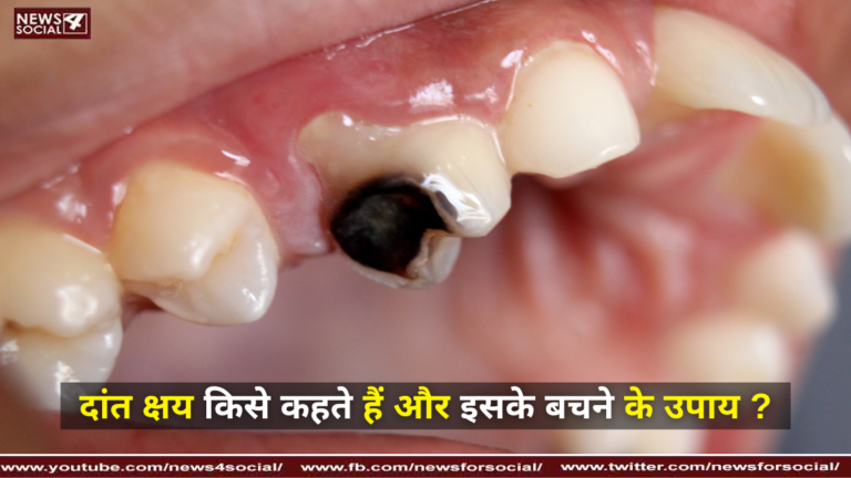 दांत क्षय किसे कहते हैं और इसके बचने के उपाय ? ( What is tooth decay and how to prevent it? )